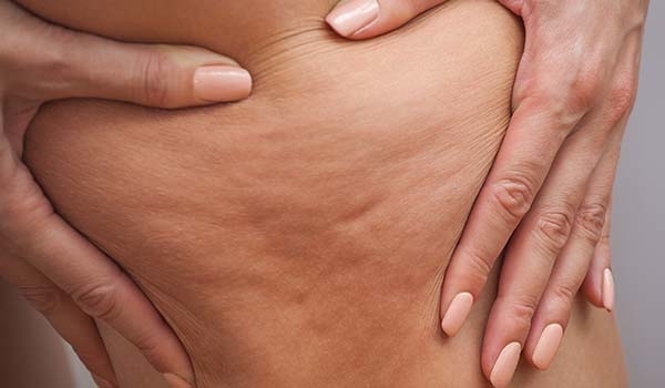 Halles-Market-articles-cellulite